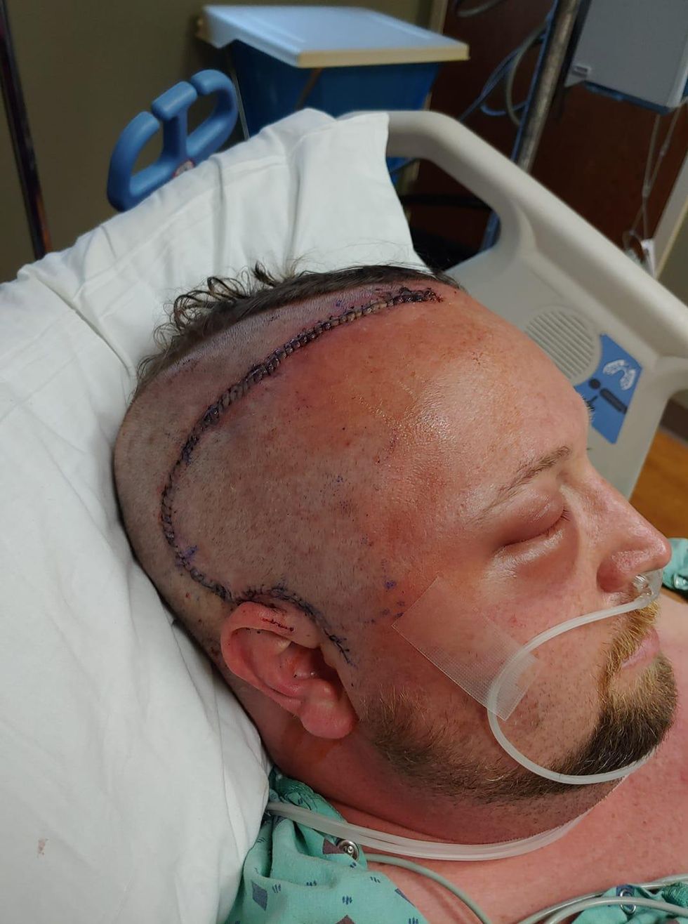 Christopher Spalding lies in a hospital bed following brain surgery. The right side of his head is shaved and is sewn from the middle of his forward to his right ear.